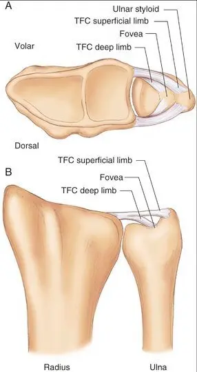 top and front views of wrist anatomy showing TFCC (Triangular Fibrocartilage Complex) components relative to the DRUJ